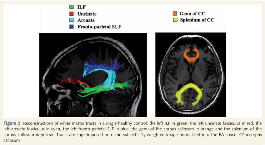 Language networks in semantic dementia