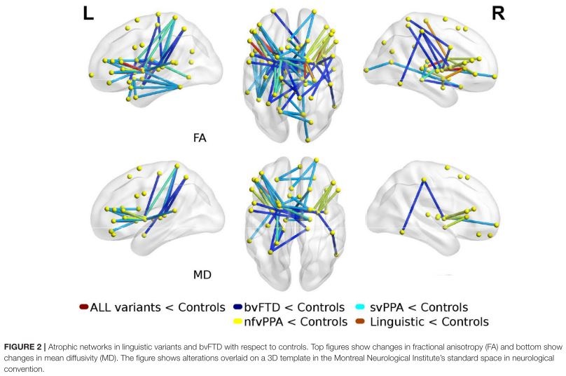 Networks disrupted in linguistic variants of frontotemporal dementia